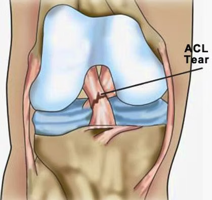 Arthroscopic Ligament Surgery