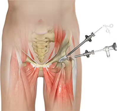 Hip Treatment and Surgery