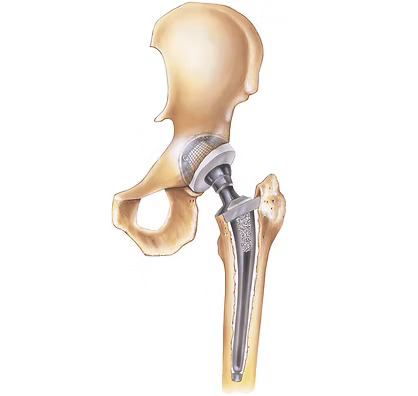 Hip Replacement (THR)