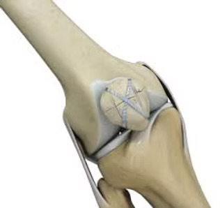 Reconstructive Knee Surgery