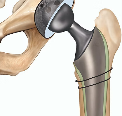 Revision Hip Replacement
