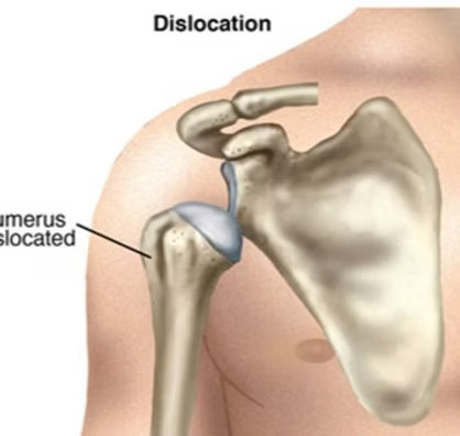 Shoulder Dislocation