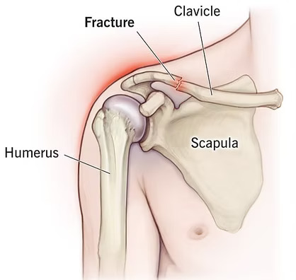 Shoulder Treatment and Surgery
