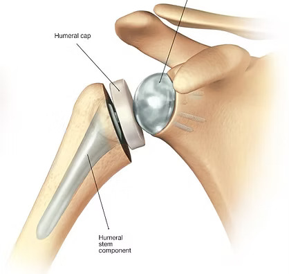 Shoulder Replacement