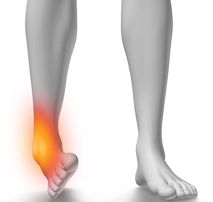 Sprains