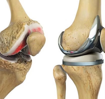 Knee Treatment and Surgery